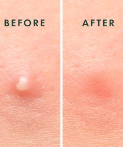 Rael Miracle Invisible Spot Cover Hydrocolloid Acne Pimple Patches (96 Ct)-Bitadi