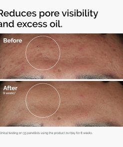 The Ordinary Niacinamide 10% + Zinc 1%, Smoothing Serum for Blemish-Prone Skin