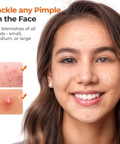 TKTK 443 Count Pimple Patches for Face, Hydrocolloid Acne Cover Patch Bulk