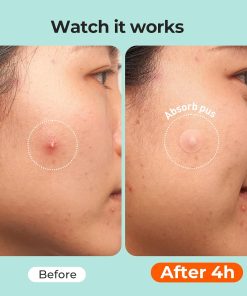 TKTK 443 Count Pimple Patches for Face, Hydrocolloid Acne Cover Patch Bulk